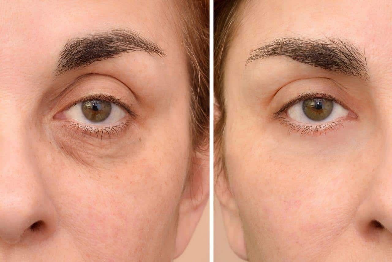 dermal fillers under eyes