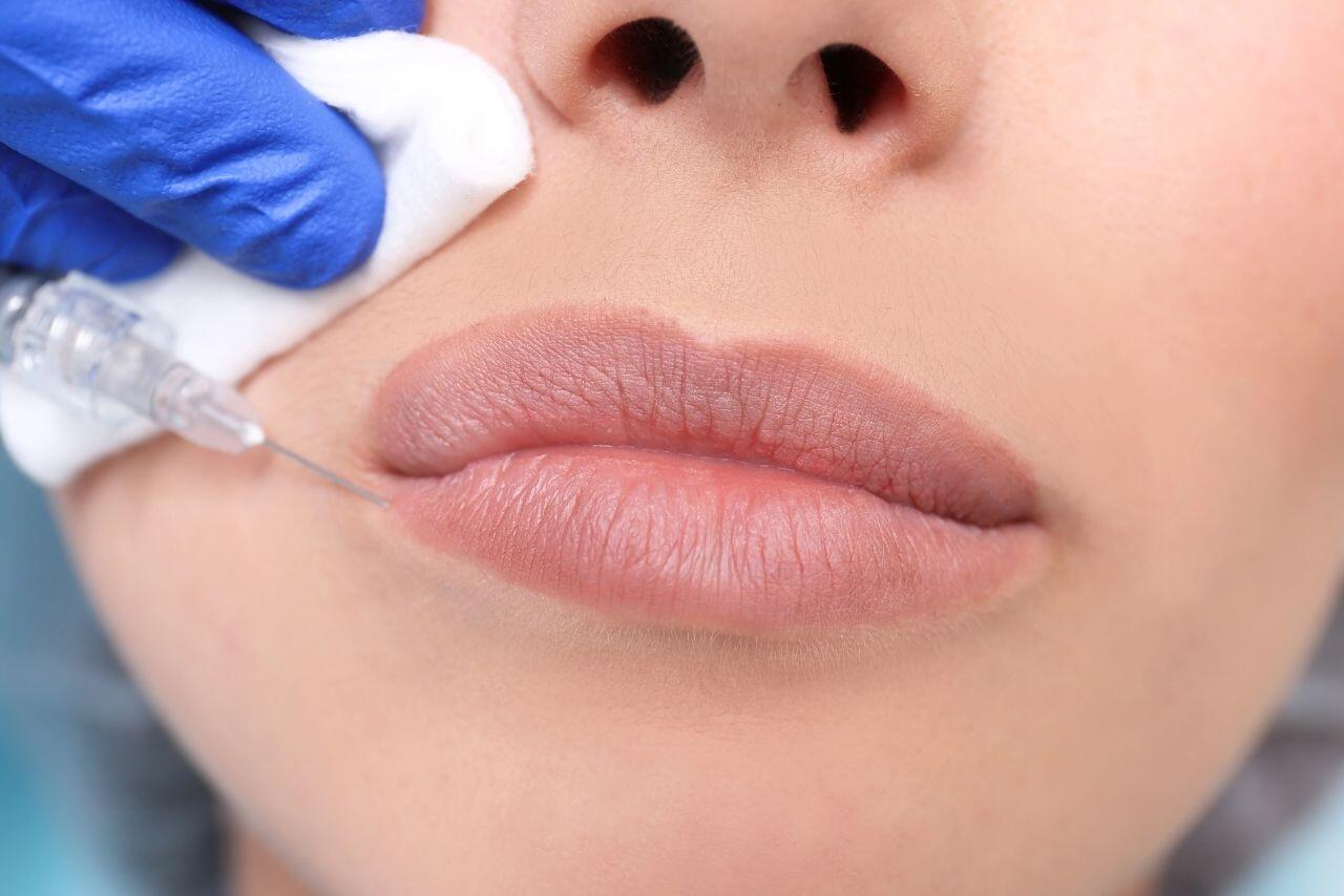 lip filler online