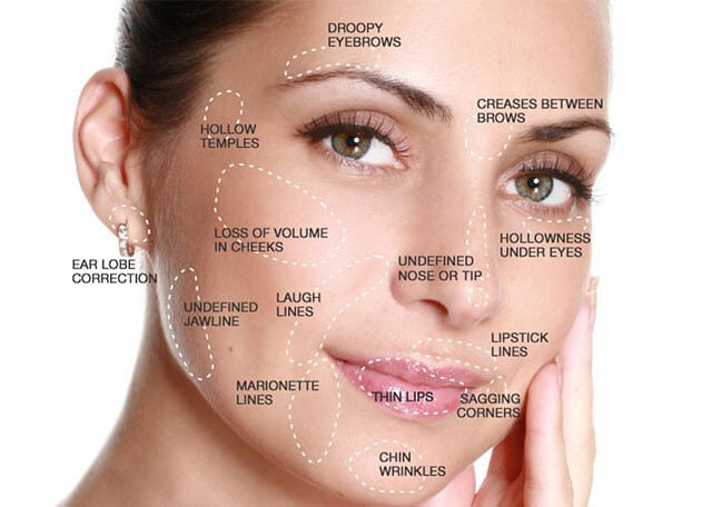 dermal filler treatment areas