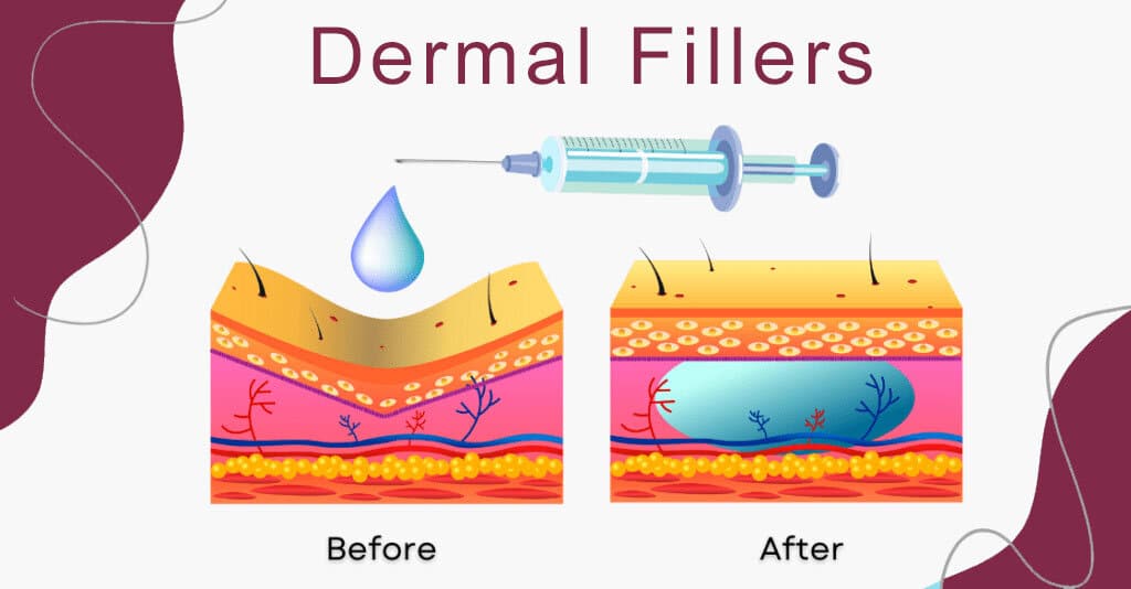 Guide to Dermal Fillers