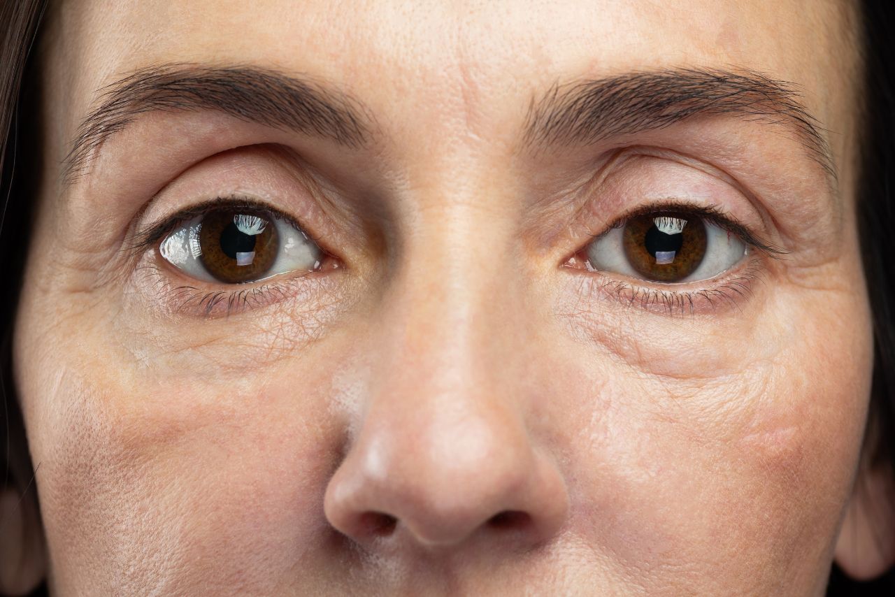 Juvederm A Replacement for Blepharoplasty