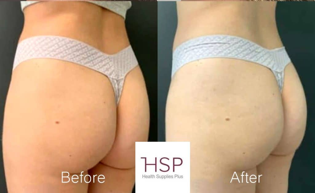 Side-by-side comparison of a patient's buttocks before and after a Sculptra BBL treatment, showing enhanced projection, a more rounded shape, and a subtle lift.