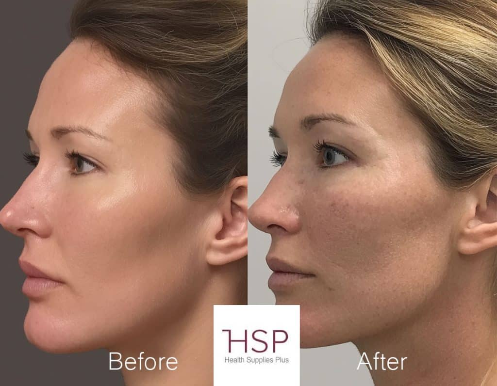 Before and after photos of a patient's jawline treated with Sculptra, showing a sharper, more defined contour and a reduction in the appearance of jowls