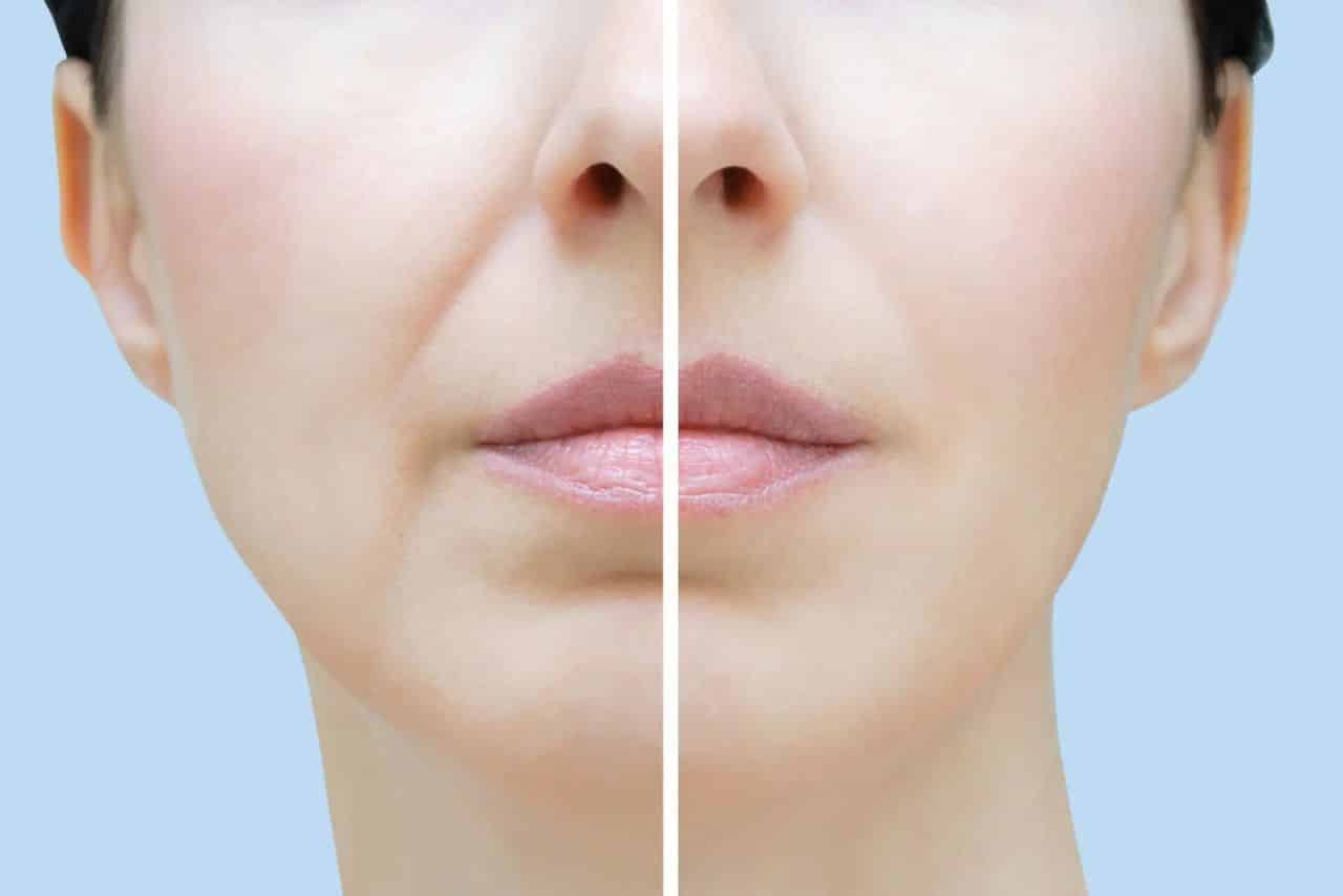 Dermal fillers for Nasolabial Folds