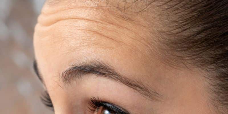 Forehead wrinkles and dermal fillers