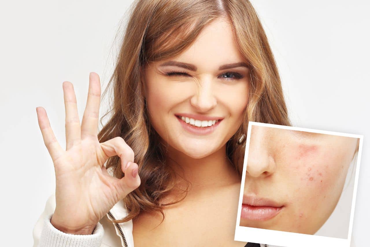 Juvederm for Acne Scars