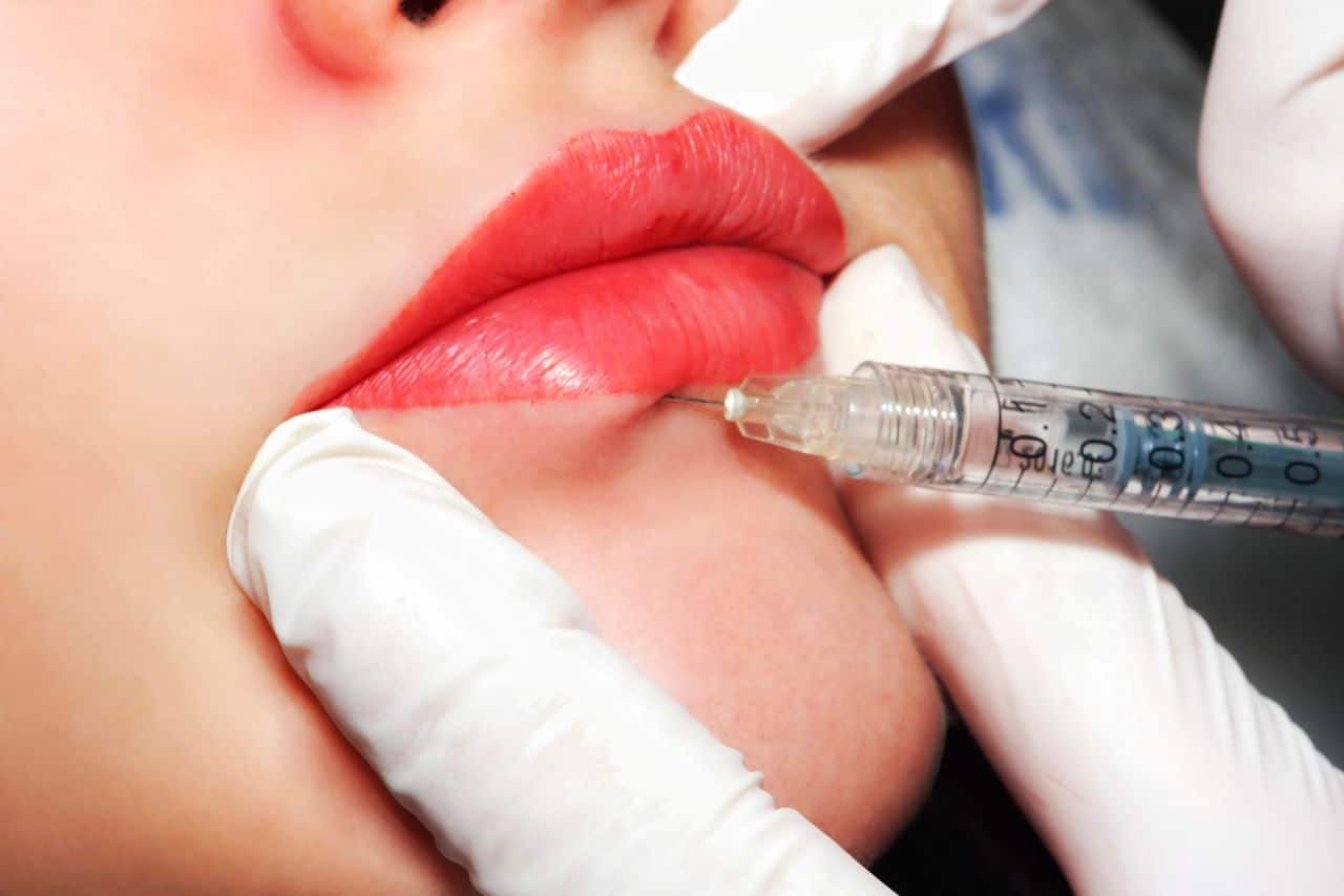 Lip Enhancement with Dermal Fillers