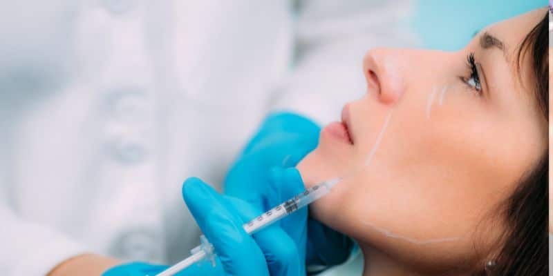 Treating Smile Lines with Dermal Fillers